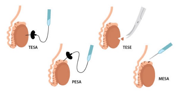 Illustration showing four types of sperm retrieval techniques: TESA, PESA, TESE, and MESA used in male infertility treatment.